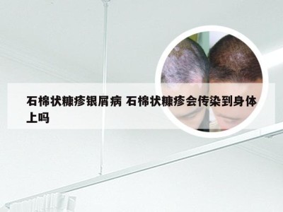 石棉状糠疹银屑病 石棉状糠疹会传染到身体上吗