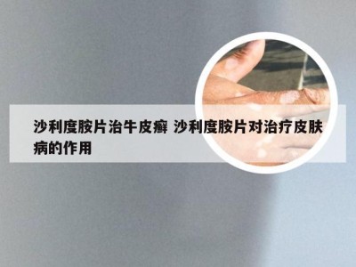 沙利度胺片治牛皮癣 沙利度胺片对治疗皮肤病的作用