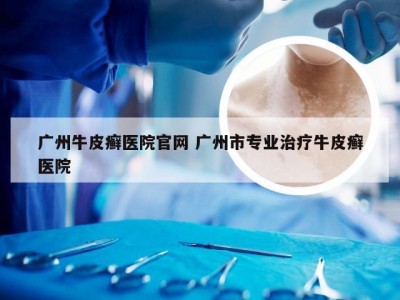 广州牛皮癣医院官网 广州市专业治疗牛皮癣医院