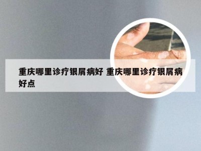 重庆哪里诊疗银屑病好 重庆哪里诊疗银屑病好点