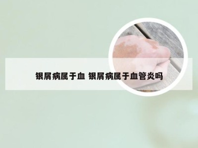 银屑病属于血 银屑病属于血管炎吗
