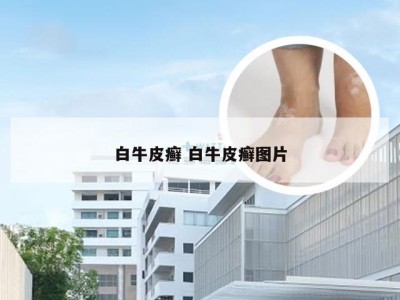 白牛皮癣 白牛皮癣图片