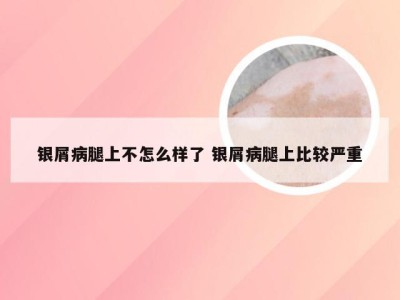银屑病腿上不怎么样了 银屑病腿上比较严重