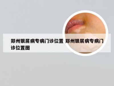 郑州银屑病专病门诊位置 郑州银屑病专病门诊位置图