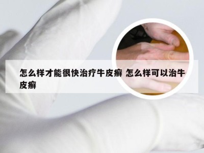怎么样才能很快治疗牛皮癣 怎么样可以治牛皮癣