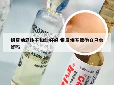 银屑病忍住不扣能好吗 银屑病不管他自己会好吗