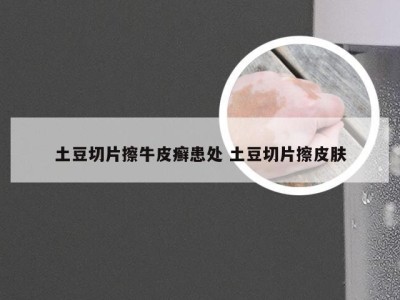土豆切片擦牛皮癣患处 土豆切片擦皮肤