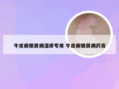 牛皮癣银屑病湿疹专用 牛皮癣银屑病药膏