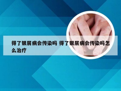 得了银屑病会传染吗 得了银屑病会传染吗怎么治疗