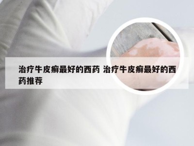 治疗牛皮癣最好的西药 治疗牛皮癣最好的西药推荐