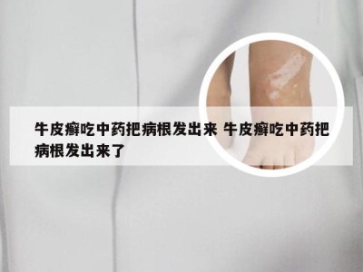 牛皮癣吃中药把病根发出来 牛皮癣吃中药把病根发出来了