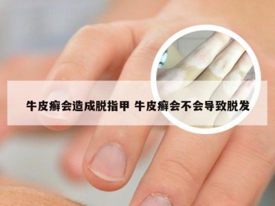 牛皮癣会造成脱指甲 牛皮癣会不会导致脱发