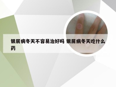 银屑病冬天不容易治好吗 银屑病冬天吃什么药