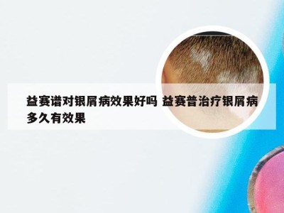 益赛谱对银屑病效果好吗 益赛普治疗银屑病多久有效果