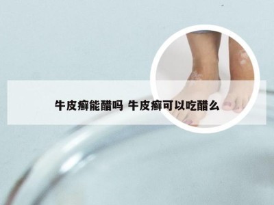 牛皮癣能醋吗 牛皮癣可以吃醋么