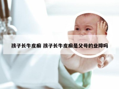孩子长牛皮癣 孩子长牛皮癣是父母的业障吗