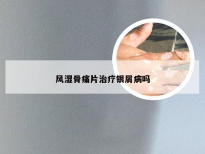 风湿骨痛片治疗银屑病吗