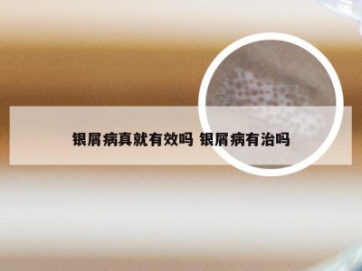 银屑病真就有效吗 银屑病有治吗