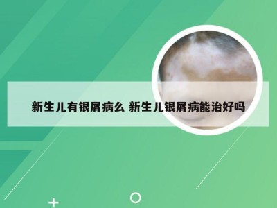 新生儿有银屑病么 新生儿银屑病能治好吗