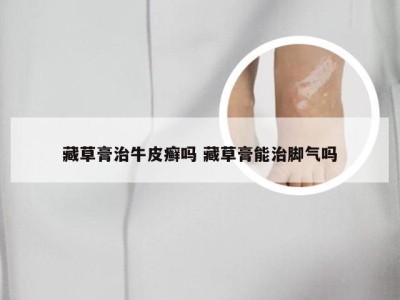 藏草膏治牛皮癣吗 藏草膏能治脚气吗