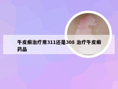 牛皮癣治疗用311还是308 治疗牛皮癣药品