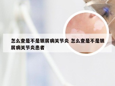 怎么查是不是银屑病关节炎 怎么查是不是银屑病关节炎患者