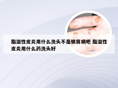 脂溢性皮炎用什么洗头不是银屑病吧 脂溢性皮炎用什么药洗头好