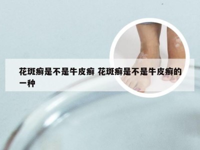 花斑癣是不是牛皮癣 花斑癣是不是牛皮癣的一种