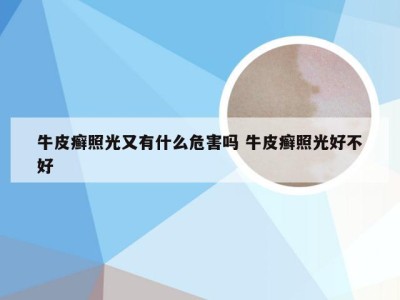 牛皮癣照光又有什么危害吗 牛皮癣照光好不好