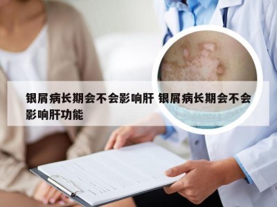 银屑病长期会不会影响肝 银屑病长期会不会影响肝功能