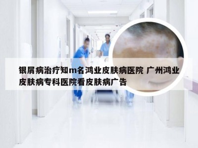 银屑病治疗知m名鸿业皮肤病医院 广州鸿业皮肤病专科医院看皮肤病广告