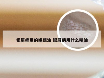 银屑病用的媒焦油 银屑病用什么精油