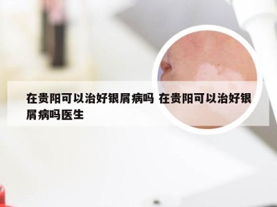 在贵阳可以治好银屑病吗 在贵阳可以治好银屑病吗医生