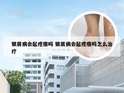 银屑病会起疙瘩吗 银屑病会起疙瘩吗怎么治疗