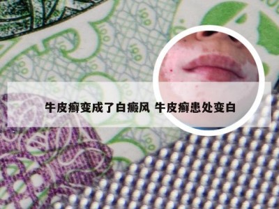 牛皮癣变成了白癜风 牛皮癣患处变白