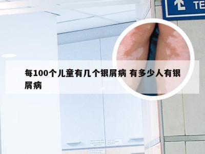 每100个儿童有几个银屑病 有多少人有银屑病