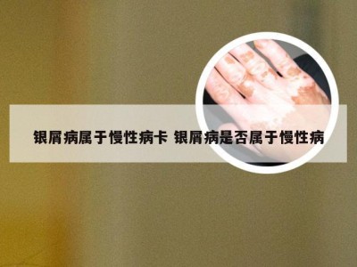 银屑病属于慢性病卡 银屑病是否属于慢性病