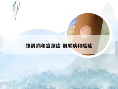 银屑病和宫颈癌 银屑病和癌症