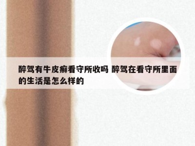 醉驾有牛皮癣看守所收吗 醉驾在看守所里面的生活是怎么样的