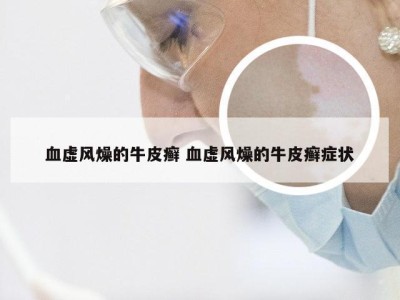 血虚风燥的牛皮癣 血虚风燥的牛皮癣症状