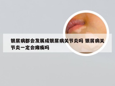 银屑病都会发展成银屑病关节炎吗 银屑病关节炎一定会瘫痪吗