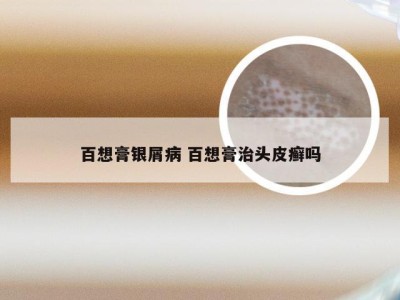 百想膏银屑病 百想膏治头皮癣吗