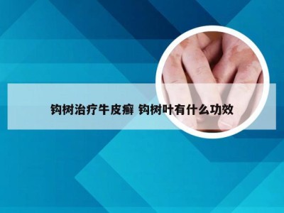 钩树治疗牛皮癣 钩树叶有什么功效