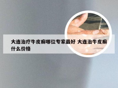 大连治疗牛皮癣哪位专家最好 大连治牛皮癣什么价格