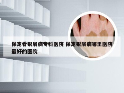保定看银屑病专科医院 保定银屑病哪里医院最好的医院