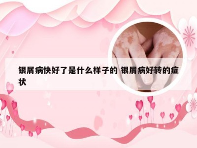 银屑病快好了是什么样子的 银屑病好转的症状