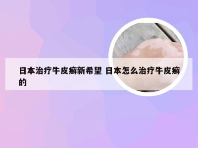日本治疗牛皮癣新希望 日本怎么治疗牛皮癣的