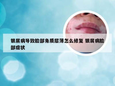 银屑病导致脸部角质层薄怎么修复 银屑病脸部症状