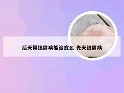 后天得银屑病能治愈么 先天银屑病
