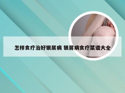 怎样食疗治好银屑病 银屑病食疗菜谱大全